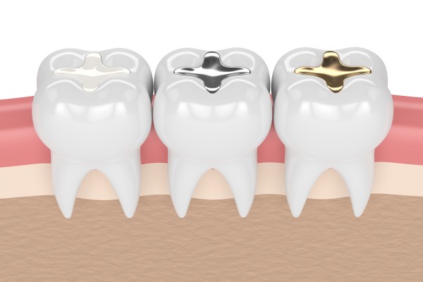 Does A Tooth Filling Last Forever?